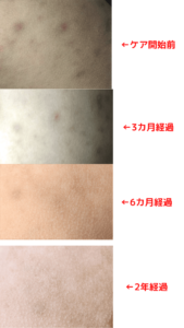 おしりの黒ずみビフォーアフター